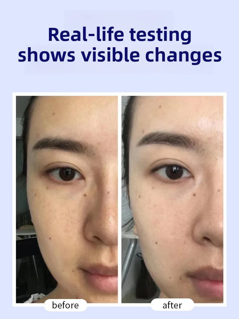 Whitening Freckle Removal Essence | Brightening Skin Care Cream