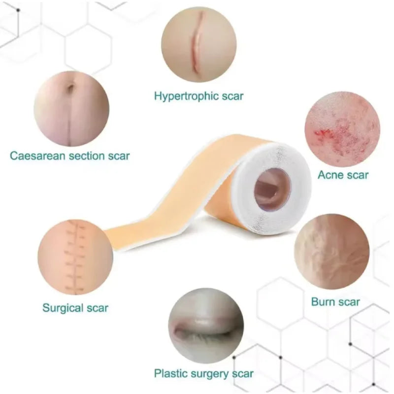 Silicone Scar Removal Strips | Effective Acne & Keloid Treatment