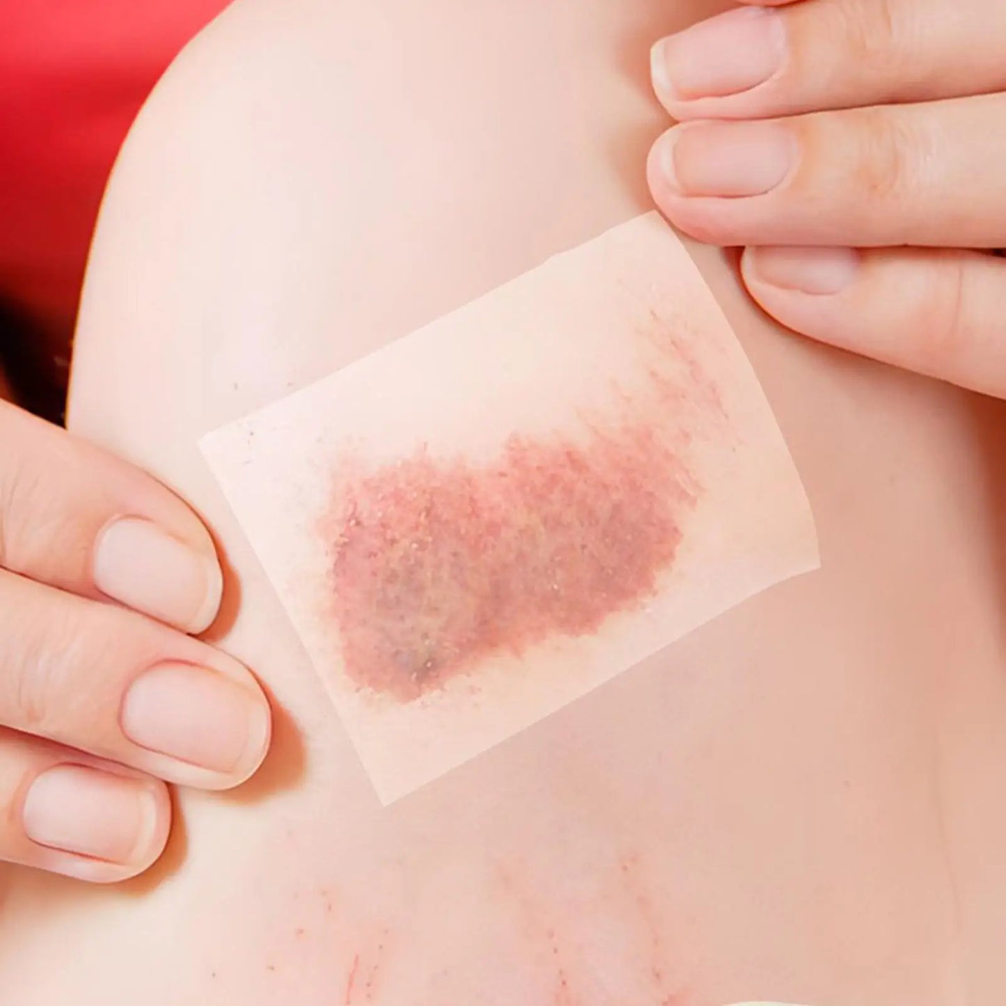 Hydrocolloid Roll Waterproof Pimple Patches | Flexible Skin Dressings