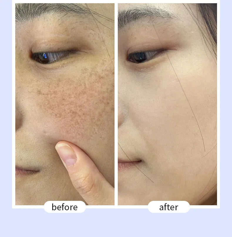 Whitening Freckle Removal Essence | Brightening Skin Care Cream