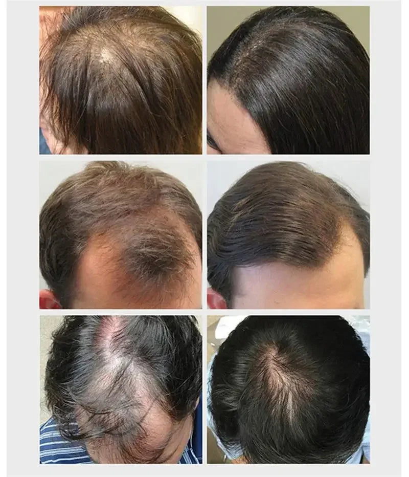 Ginger Hair Growth Essential Oil | Anti-loss Regrowth Serum