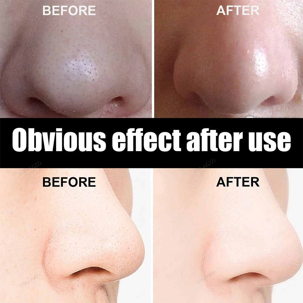 50/100PCS Charcoal Nose Strips for Blackhead Removal & Acne Treatment