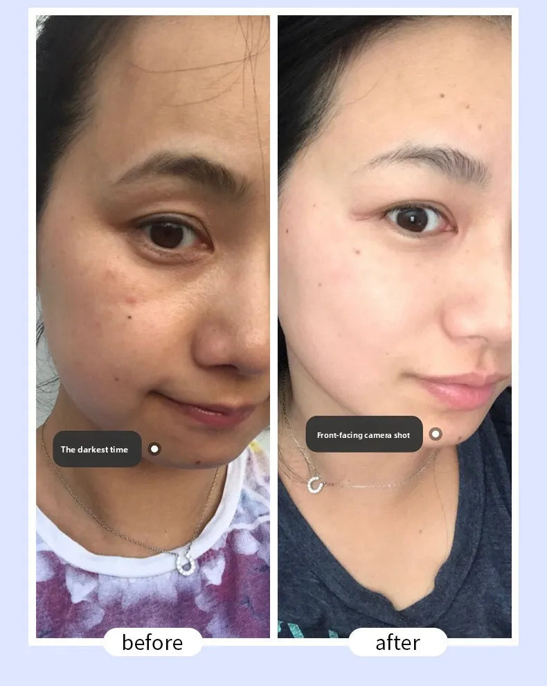 Whitening Freckle Removal Essence | Brightening Skin Care Cream