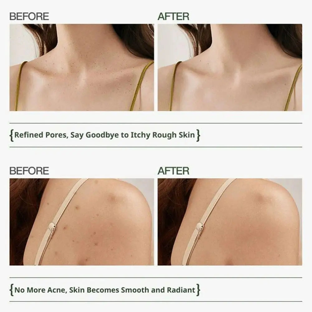 Revitalizing Body Spray for Clear, Smooth Skin | Acne & Oil Control