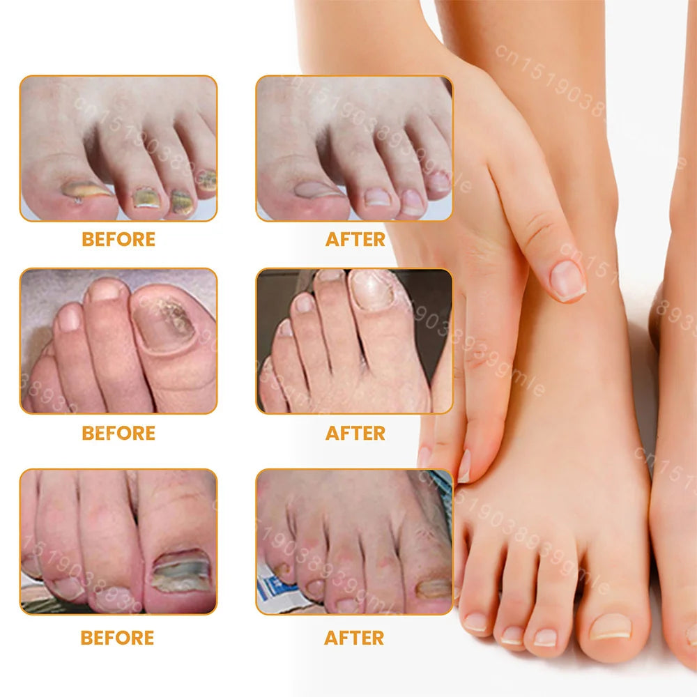 Toenail Fungus Repair Patches | Nail Care for Discolored Nails