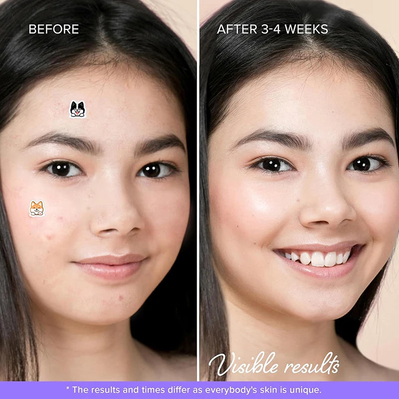 100pcs Invisible Acne Pimple Patches for Rapid Skin Healing