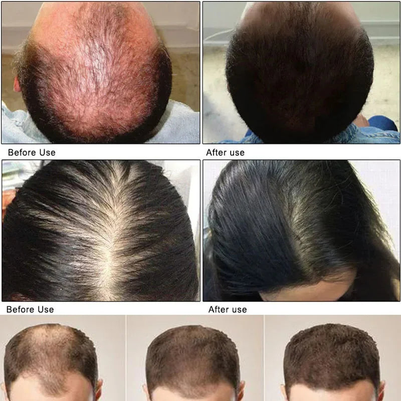 Ginger Hair Growth Essential Oil | Anti-loss Regrowth Serum